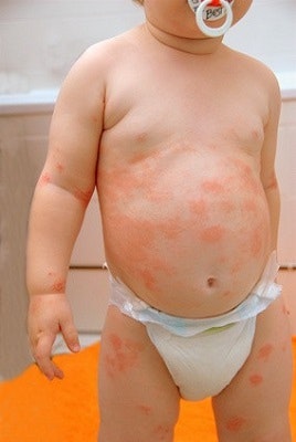 Hautrötungen bei einem Baby aufgrund Neurodermitis Hautrötungen bei einem Baby aufgrund Neurodermitis