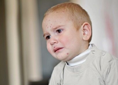 Kleinkind hat Neurodermitis im Gesicht