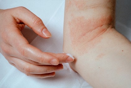 Mensch mit Neurodermitis cremt eine betroffene Stelle in der Armbeuge ein. Mensch mit Neurodermitis cremt eine betroffene Stelle in der Armbeuge ein.