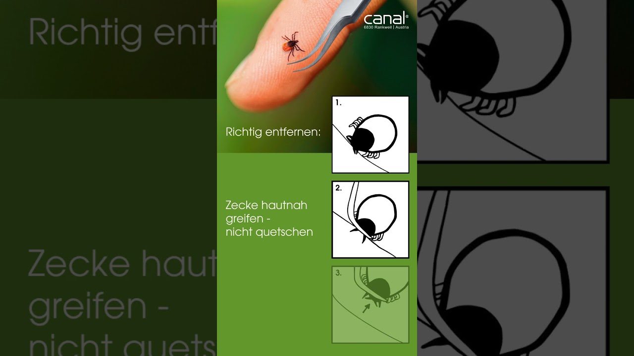 Zeckenpinzette rostfrei